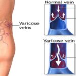 Varicose veins is a highly ignored condition