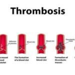 Thrombosis cases have shown a four-fold increase in the last 10 years