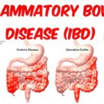 Processed foods and additives exacerbate chances of acquiring inflammatory bowel diseases