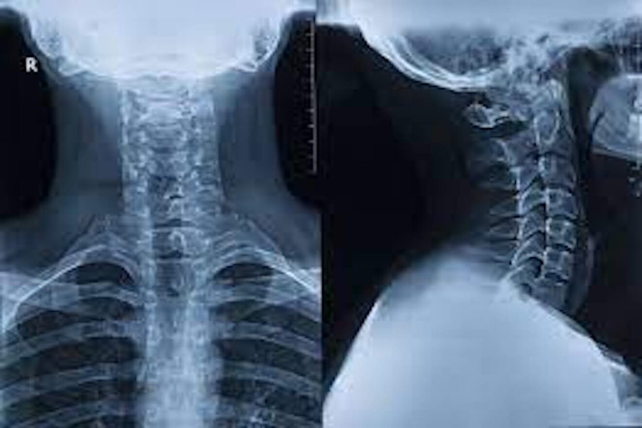 Understanding Cervical Ribs or Extra Ribs - HealthySoch
