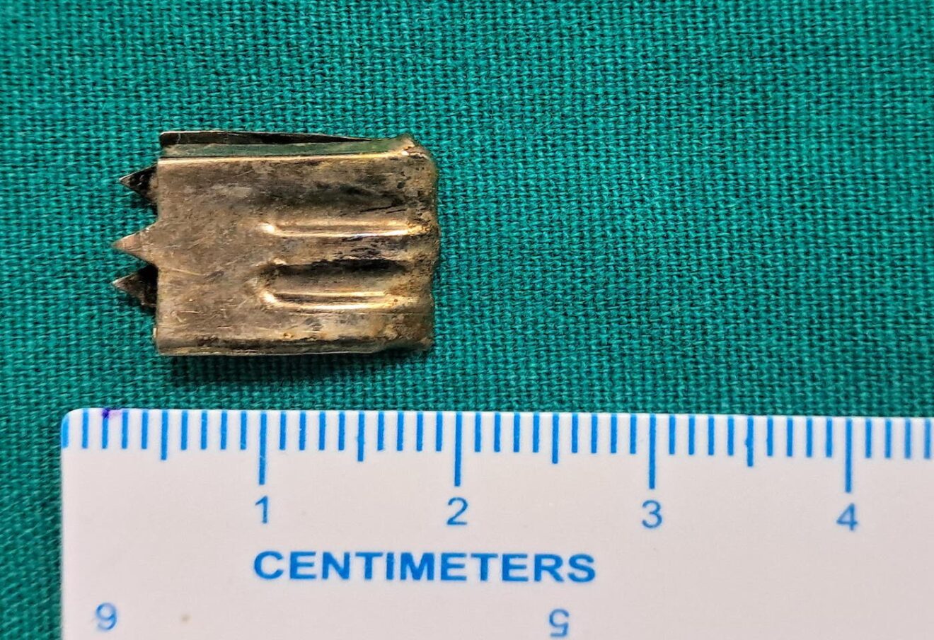 Mides Sharp Object Sharp Metallic Object Successfully Removed From 10-Month-Old Child’s ...
